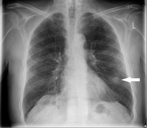 Investigating the solitary pulmonary nodule | The BMJ