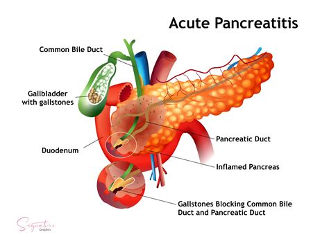 Acute Pancreatitis Article