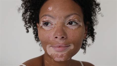 What is 'Vitiligo'? | rocketcitynow.com