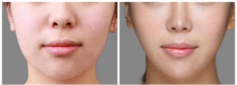 Botox Face Slimming - Visage Sculpture