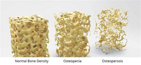 Bone density osteoporosis and your T- score, [2022]