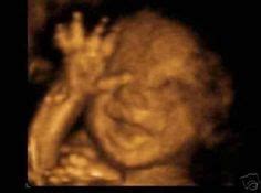 The Ham | 10 Surprising Ultrasound Photos Of Babies With A Sense Of ...