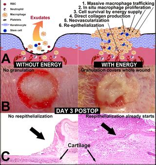 Granulation Tissue Wound Healing Pictures - focistalany