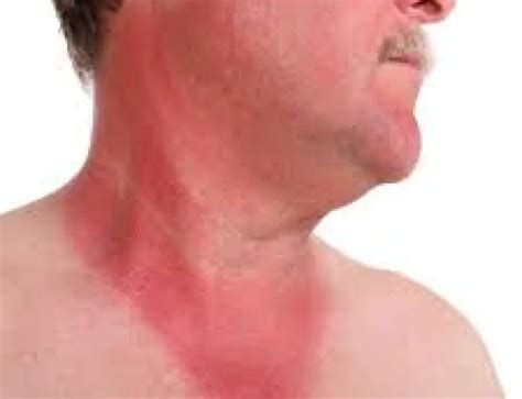 Sun Poisoning on Face – How to Treat Swollen, Blisters from Sun Poisoning on Face