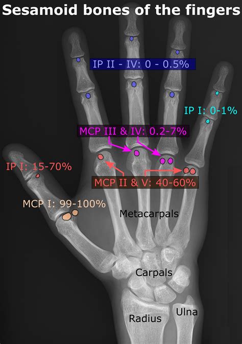 Sesamoid Bone Hand Therapy | What are sesamoid bones for?