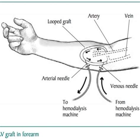 (PDF) Hemodialysis graft (Arteriovenous Grafts) Thrombosis