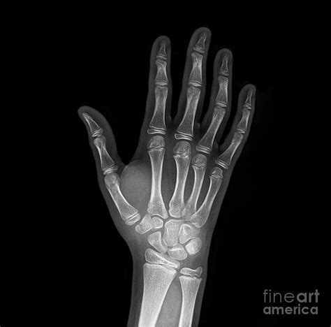 Broken Wrist Bone, X-ray Photograph by Science Photo Library