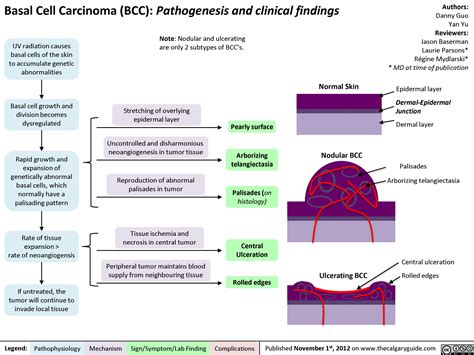 Basal Cell Carcinoma Diagram