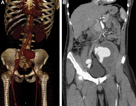 Bilateral external iliac artery aneurysm in a young man - Journal of ...