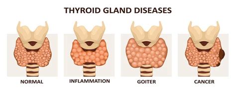 Why do I have Thyroid Nodules? - RFA For Life Blog