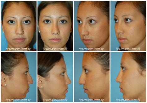 Low Bridge / Glabella Before and After Photo Gallery - Nose Surgery Photos