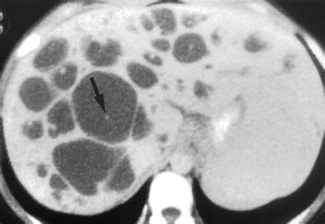 Caroli's Disease: Radiologic Spectrum with Pathologic Correlation | AJR