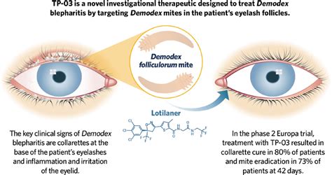 Tarsus takes on Demodex blepharitis with TP-03: a first-in-class, anti ...