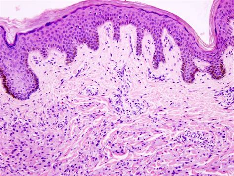 Granular Cell Tumor Histology