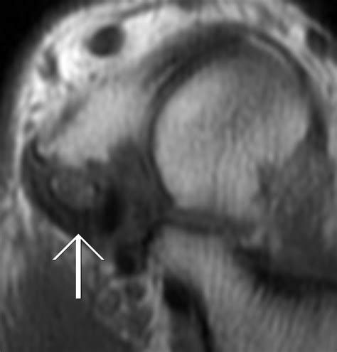 Os Navicularis Syndrome-MRI - Sumer's Radiology Blog