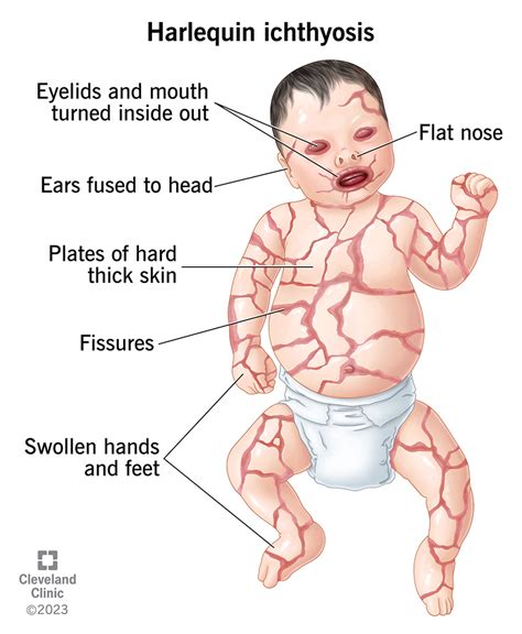 Harlequin Ichthyosis (HI): Causes, Symptoms & Treatment