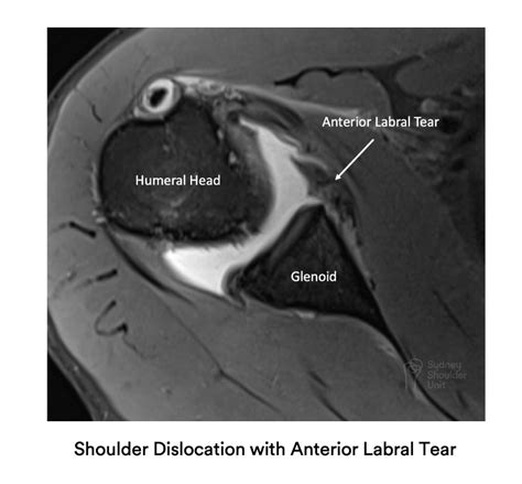 Mri Shoulder Labrum Tear