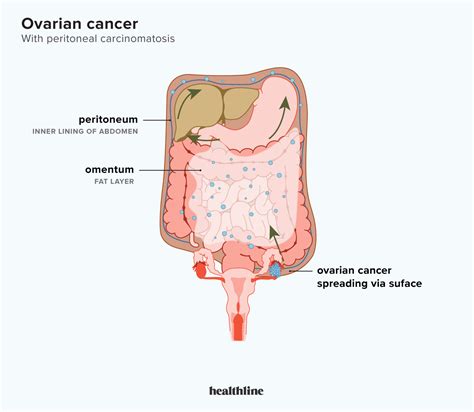 Peritoneal carcinomatosis: What is the link with ovarian cancer?