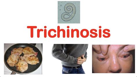 Trichinosis (Pork Parasite) | Pathophysiology, Signs & Symptoms ...