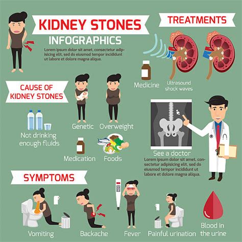 60+ Lithotripsy Stock Illustrations, Royalty-Free Vector Graphics & Clip Art - iStock