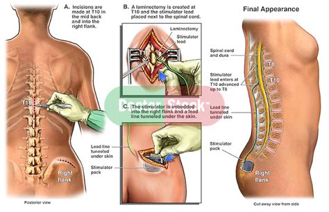 Placement of Thoracic Spinal Cord Stimulator | Doctor Stock