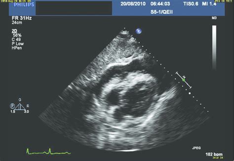 Echocardiogram illustrating moderate-sized pericardial effusion with ...