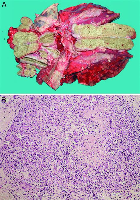 Bovine tuberculosis lesions in a ewe. A, soft, caseous lesions and ...