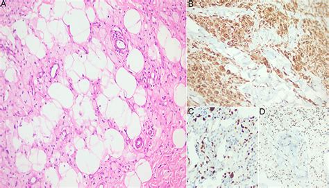 Surgical treatment of tuberous and tendinous xanthoma | CCID