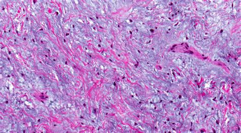 Odontogenic Myxoma Histology