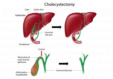 Laparoscopic surgery. Technical surgery which operations are performed far from their location ...