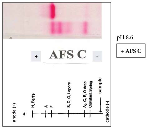 Haemoglobin electrophoresis and HPLC – HAEMA