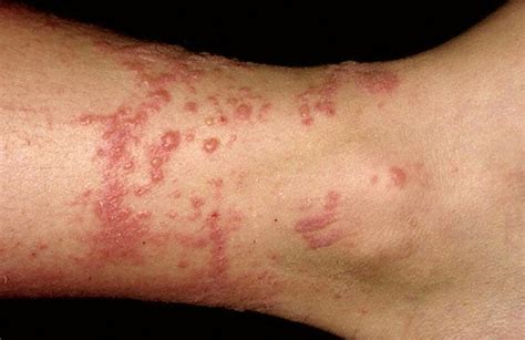 Contact Dermatitis - Pictures, Symptoms, Causes, Treatment - HubPages