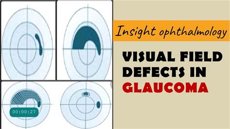 Which Is And Nasal Visual Field Interpretation