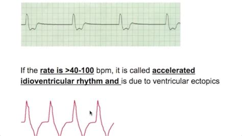 Junctional Escape Rhythm Treatment