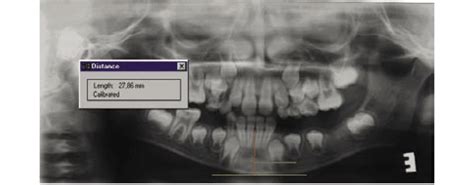 Landmark of a line between the anterior nasal spine and the most ...