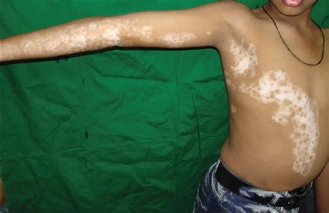 Segmental vitiligo, causes, symptoms, diagnosis, treatment & prognosis