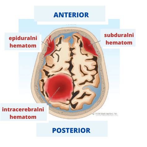 Epiduralni hematom