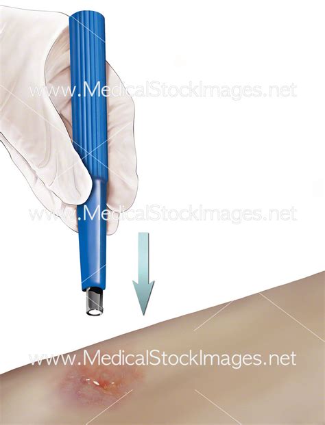 A Punch Biopsy Procedure – Medical Stock Images Company