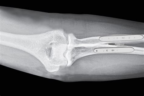 RADIOULNAR SYNOSTOSIS POSTTRAUMATIC | Hand Surgery Source