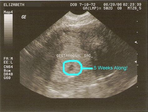 FISHER FAMILY ADDITION...: 5 Week Ultrasound...