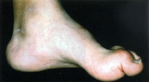 Cavovarus Foot Correction - Dr Greg Sterling