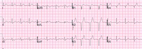 Dr. Smith's ECG Blog: Subtle Anterior STEMI Superimposed on Anterior LV ...