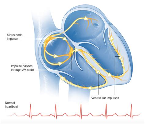 Bradycardia – Hope For Hearts