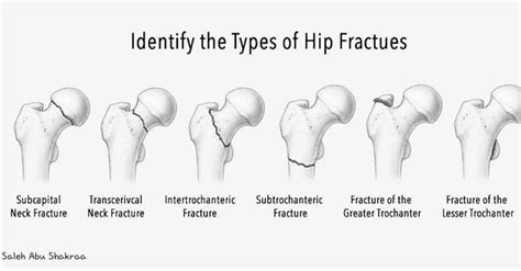 Pin by Luisvaldivieso on osteomuscular | Neck fracture, Greater trochanter, Fractures