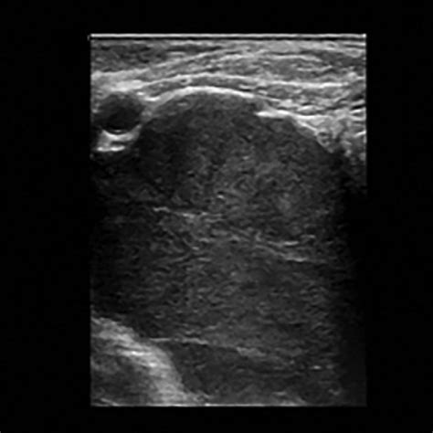 -Ultrasound-guided biopsy of right anterior mediastinal mass. (A)... | Download Scientific Diagram