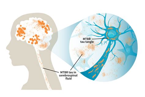 Novel form of Alzheimer's protein found in spinal fluid indicates stage of the disease - The ...