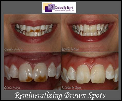 Charlotte Dentist | Teeth Whitening Brown Spots | Cosmetic Dentistry