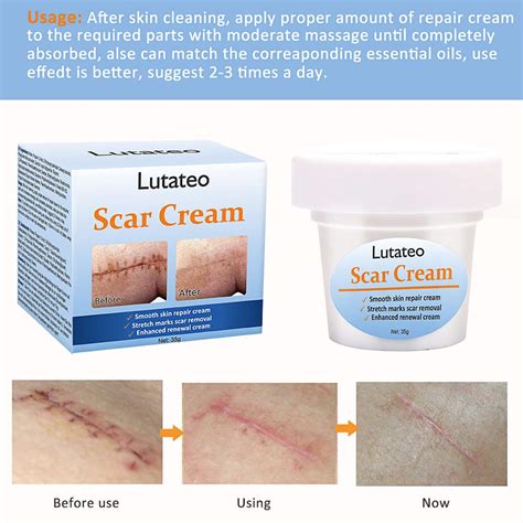 Scar Cream, Scar Treatment, Stretch Mark Cream, Scar Removal Cream, Acne Spots Treatment, Scar ...