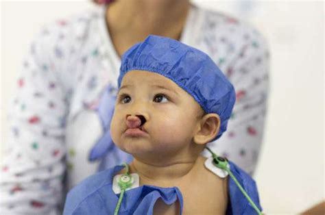 Más de 500 niños en el país quedaron a la espera de una cirugía reconstructiva de paladar ...
