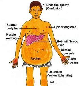 Cirrhosis of the Liver Stage 4 | Livers With Life